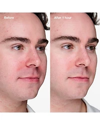 Acne Solutions Clinical Advanced Clearing Gel 0.68 oz.