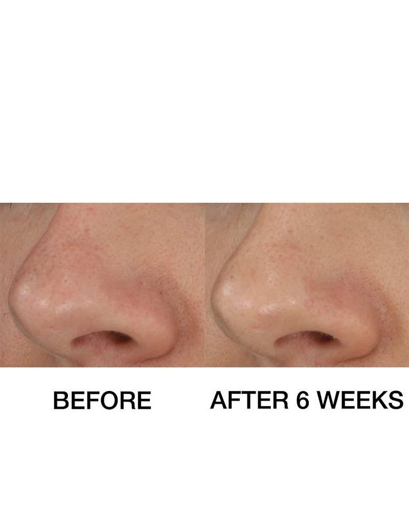 Blackhead Solutions Self-Heating Blackhead Extractor 0.7 oz.