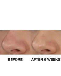 Blackhead Solutions Self-Heating Blackhead Extractor 0.7 oz.