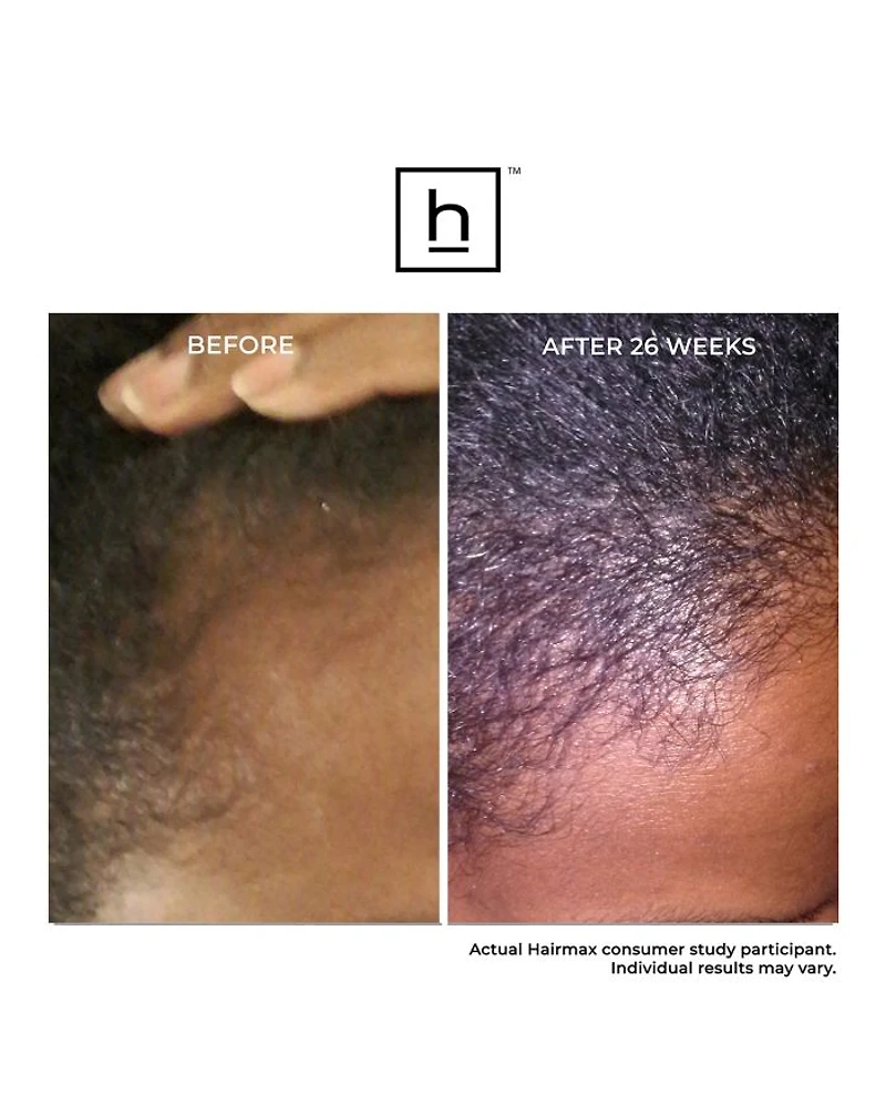 Ultima 12 Hair Growth LaserComb