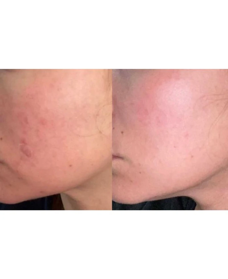 Acne Control Serum - 1.1.oz