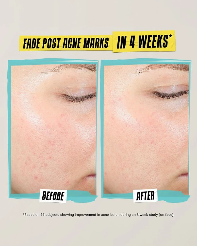 Expertly Clear Acne Treating & Preventing Lotion 2 oz.