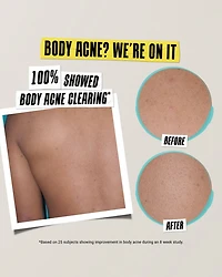 Expertly Clear Acne Treating & Preventing Lotion 2 oz.