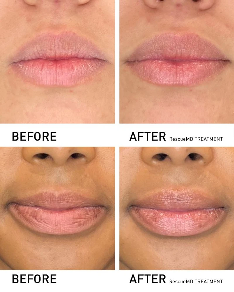 Restorative Lip Treatment 0.4 oz.