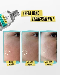 Truly Targeted Acne Clearing Solution with Salicylic Acid 0.5 oz.