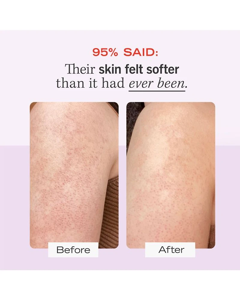 KP Bump Eraser Body Scrub with 10% AHA - Exfoliant for Keratosis Pilaris