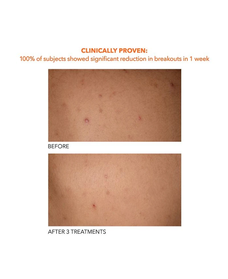 Alpha Beta® Exfoliating Body Treatment