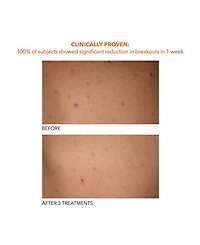 Alpha Beta® Exfoliating Body Treatment