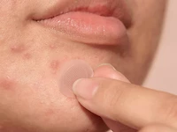 Mighty Patch™ Micropoint for Blemishes - 8 Pack
