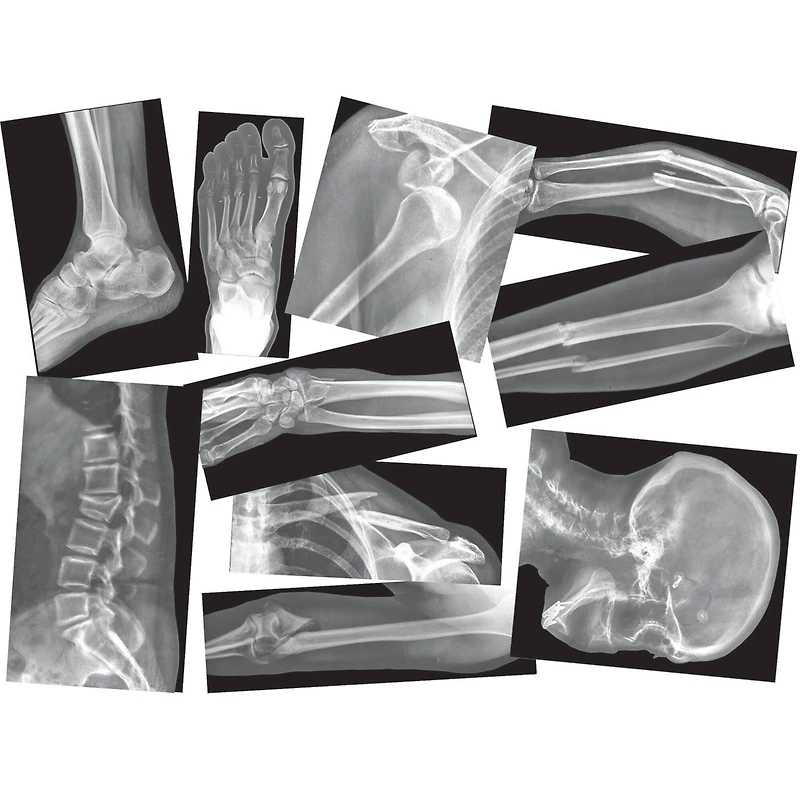 Roylco® Broken Bones X-Ray Set, Pack of 15