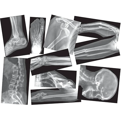 Roylco® Broken Bones X-Ray Set, Pack of 15
