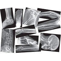 Roylco® Broken Bones X-Ray Set, Pack of 15