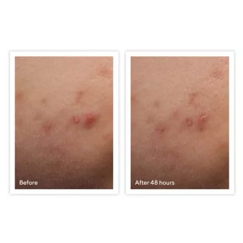 Murad Rapid Relief Spot Acne Treatment