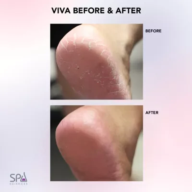 Spa Sciences Viva Advanced Pedicure Foot Smoothing System Callus Remover