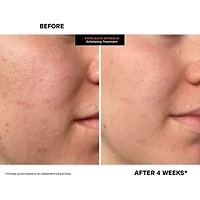 Kate Somerville ExfoliKate Intensive Exfoliating Treatment - 60 ml / 2 fl oz