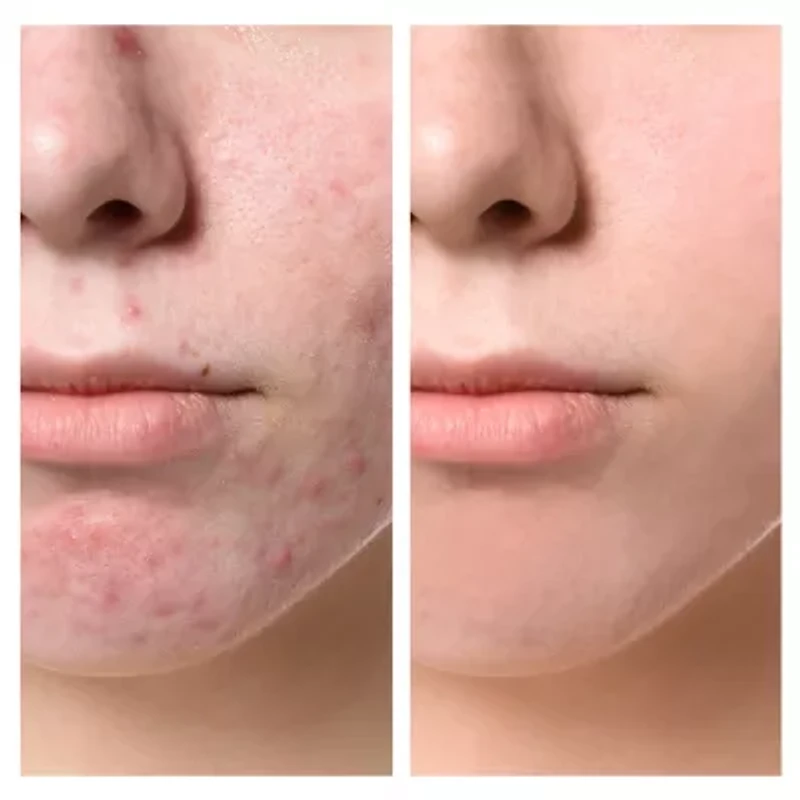 Spa Sciences Claro Acne Treatment Light Therapy System