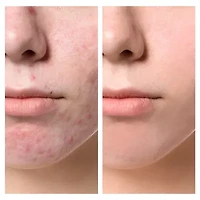 Spa Sciences Claro Acne Treatment Light Therapy System