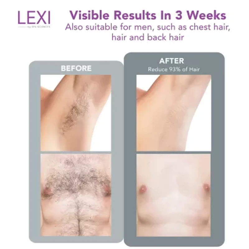 Spa Sciences Lexi Pro Ipl Hair Removal System