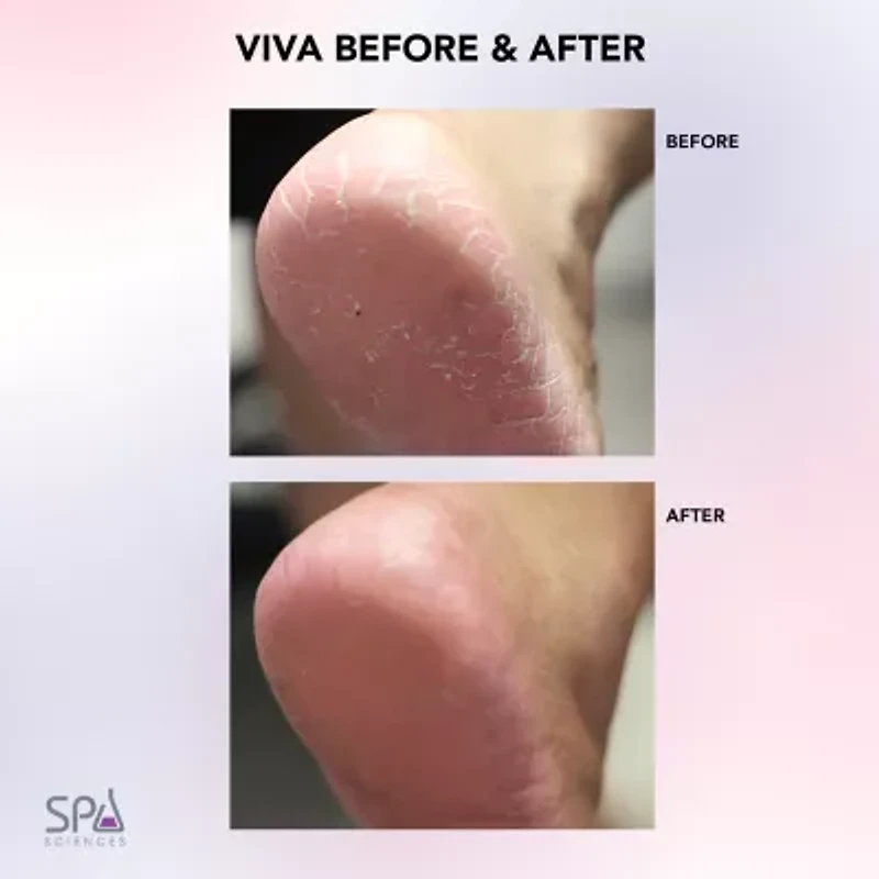 Spa Sciences Viva Advanced Pedicure Foot Smoothing System Callus Remover