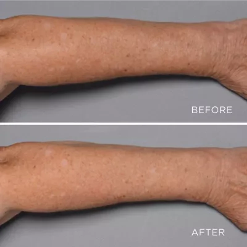 Perricone MD Cold Plasma Plus+ Fragile Skin Therapy (Tube)