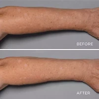 Perricone MD Cold Plasma Plus+ Fragile Skin Therapy (Tube)