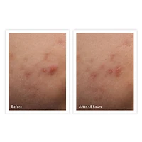 Murad Rapid Relief Spot Acne Treatment