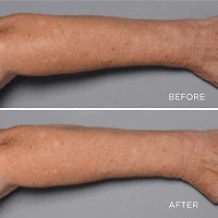 Perricone MD Cold Plasma Plus+ Fragile Skin Therapy (Tube)