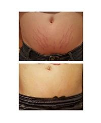 Strialite Stretchmark Device