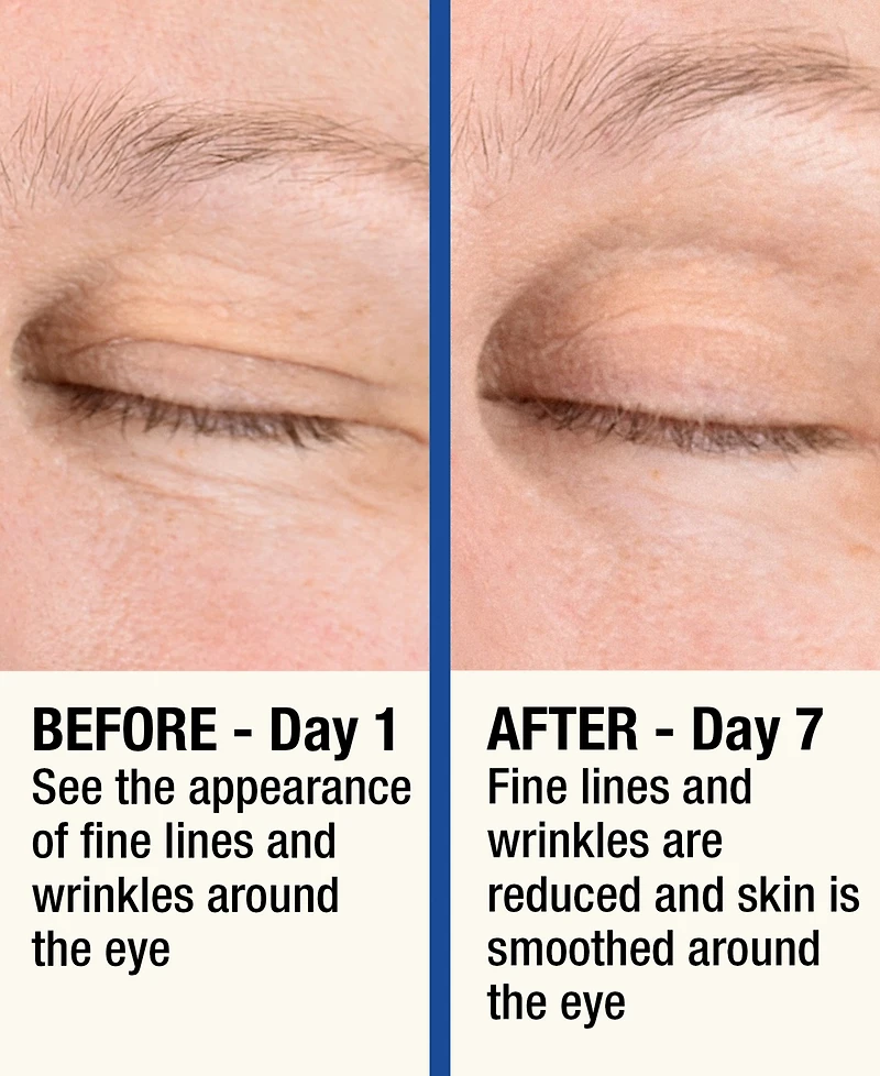 7LS by HoMedics ReMOVE Micro Dermabrasion Device with Cooling Surface