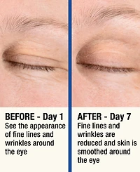 7LS by HoMedics ReMOVE Micro Dermabrasion Device with Cooling Surface