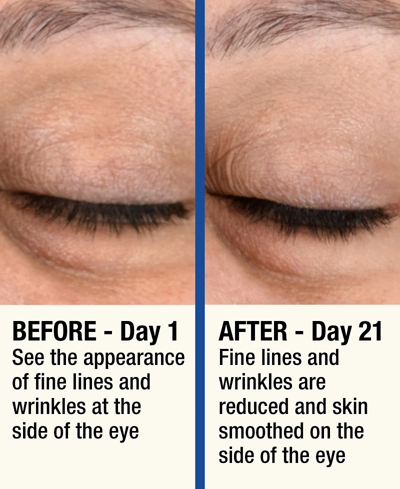 7LS by HoMedics ReMOVE Micro Dermabrasion Device with Cooling Surface