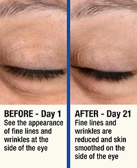 7LS by HoMedics ReMOVE Micro Dermabrasion Device with Cooling Surface