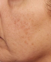 Perricone Md Vitamin C Ester Intensive Dark Spot Treatment, 1 oz.