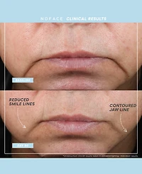 NuFACE 6-Pc. Trinity+ Complete Toning Set