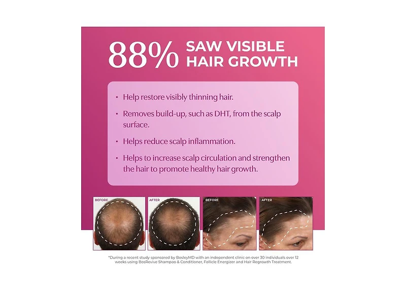 BosleyMD Women's Hair Re-growth Foam 5% Minoxidil