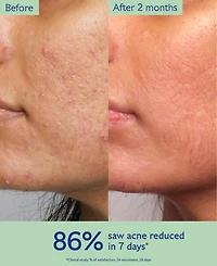 Caudalie Vinopure Treat and Prevent Blemishes Acne Serum, 1 oz.