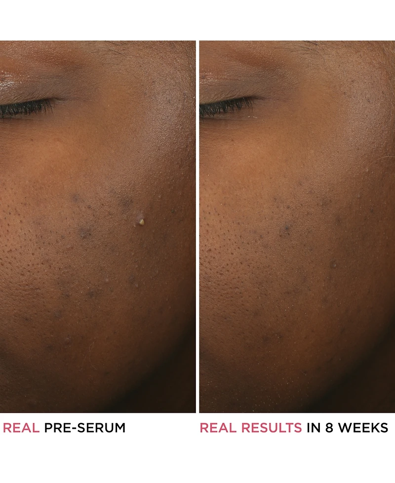 It Cosmetics Bye Bye Breakout Serum
