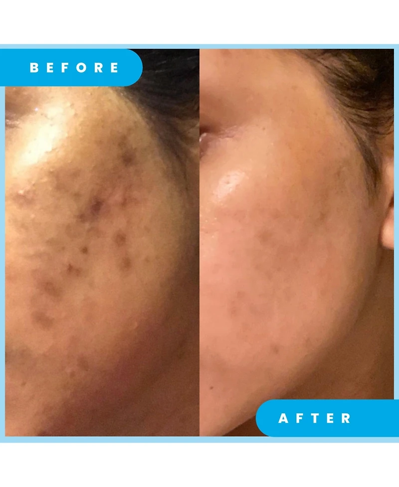 Admire My Skin Dark Spot Corrector Remover for Face Ultra Potent Brightening Serum