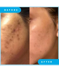 Admire My Skin Dark Spot Corrector Remover for Face Ultra Potent Brightening Serum