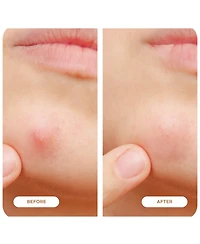 Night Silk + Salicylic Acid Microdart Pimple Patches 48-Pack