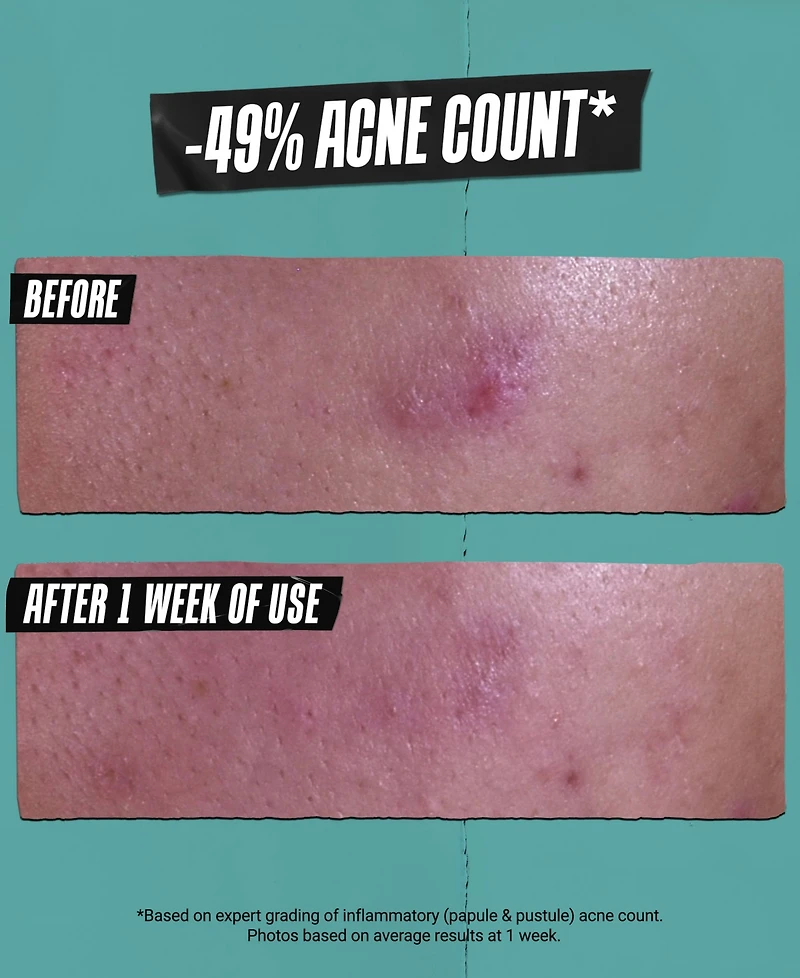 Kiehl's Since 1851 Gently Effective Acne-Treating Cleansing Paste