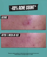 Kiehl's Since 1851 Gently Effective Acne-Treating Cleansing Paste