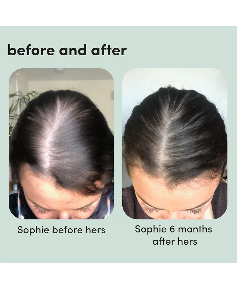 Hers Hair Regrowth Treatment Minoxidil 5% Topical Foam