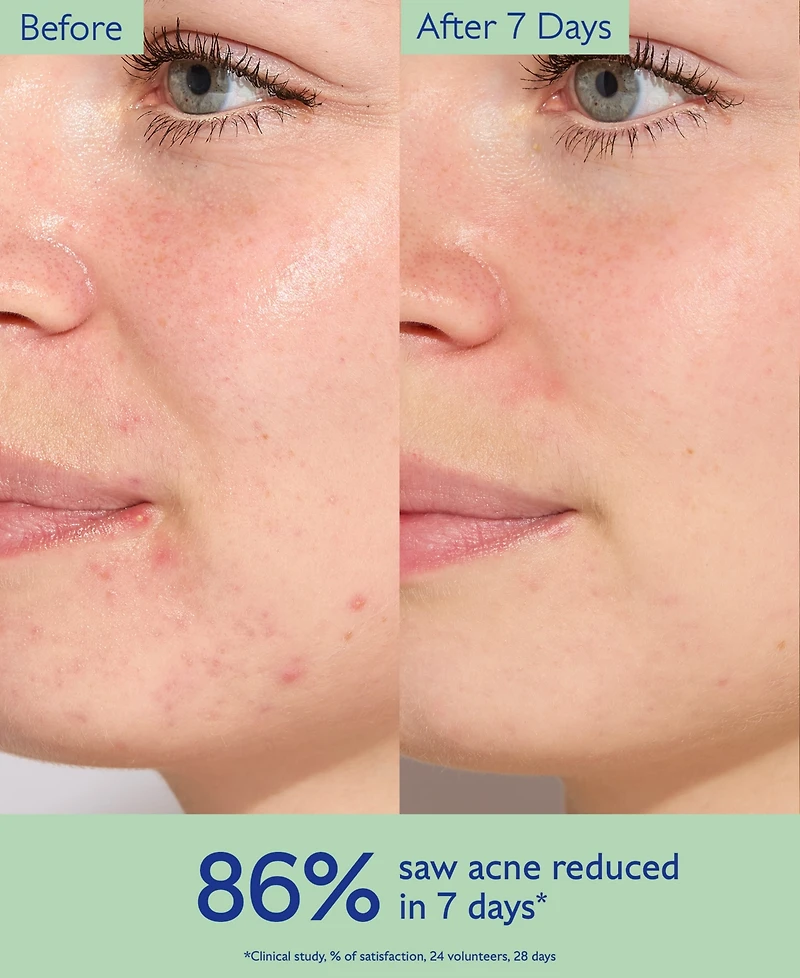 Caudalie Vinopure Treat and Prevent Blemishes Acne Serum, 1 oz.