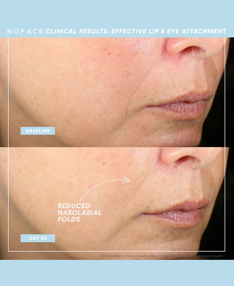 NuFACE 5-Pc. Trinity+ Targeted Facial Toning Set