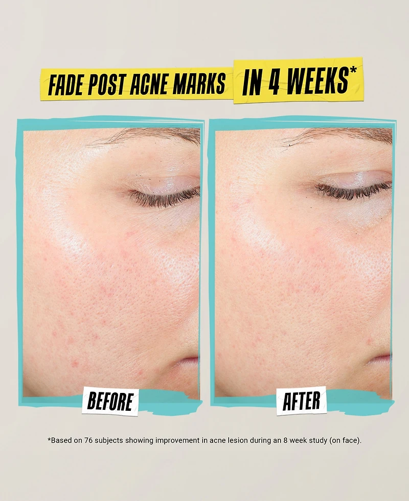 Kiehl's Since 1851 Expertly Clear Acne-Treating & Preventing Lotion
