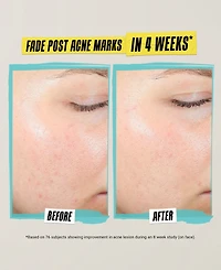 Kiehl's Since 1851 Expertly Clear Acne-Treating & Preventing Lotion