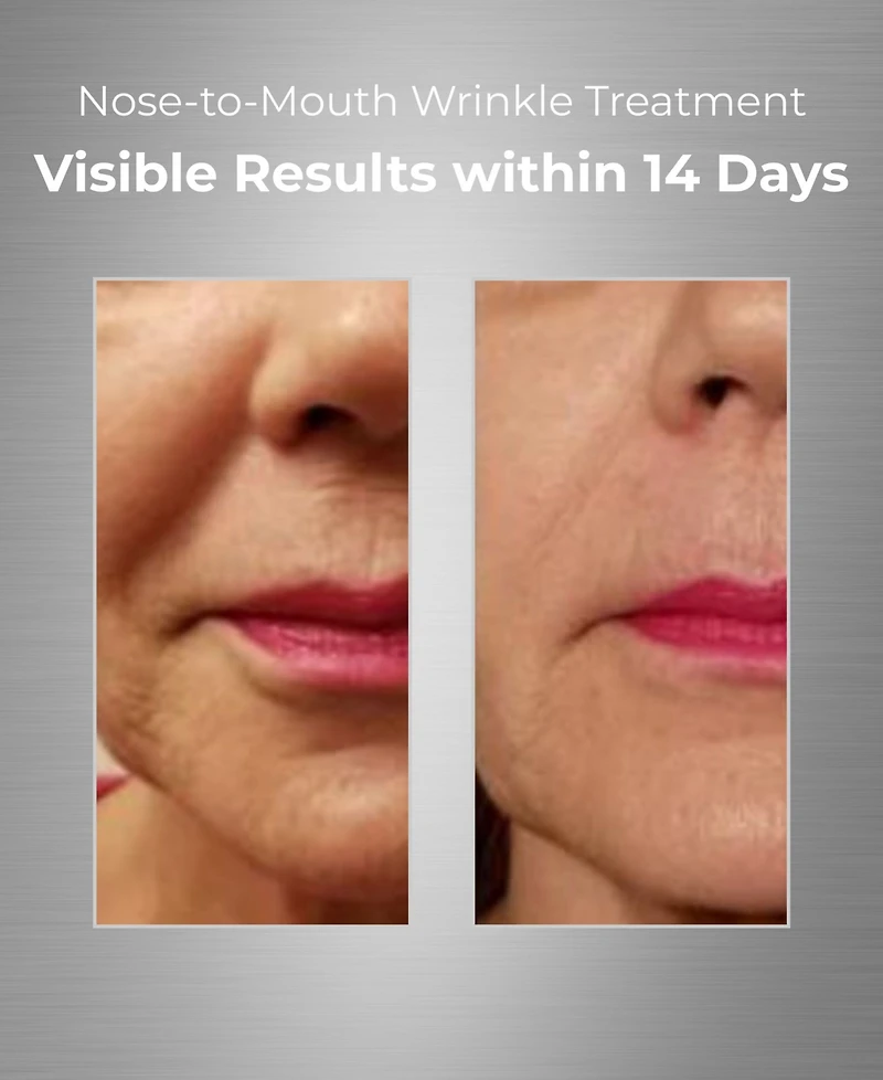 Bionova Nose-To-Mouth Wrinkle Treatment With Uv Chromophores