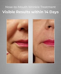 Bionova Nose-To-Mouth Wrinkle Treatment With Uv Chromophores