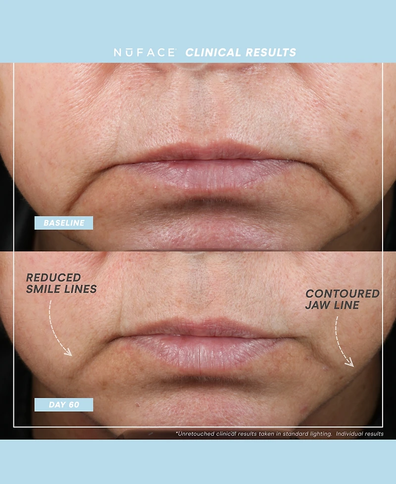 NuFACE 5-Pc. Trinity+ Targeted Facial Toning Set